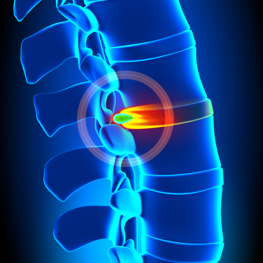 Blue heat graphic of spine showing disc herniation in red and yellow